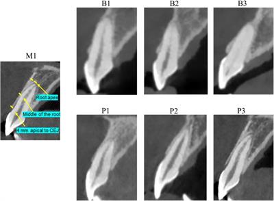 Morphology and thickness of the buccal bone wall of the maxillary central incisors in population: a CBCT study